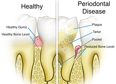 What is gum disease and how is it treated?